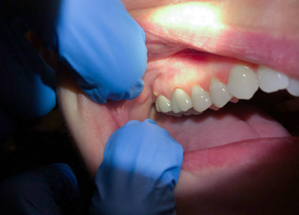 Best Broken or Cracked Tooth Emergency Dentist in New Ellenton, SC
