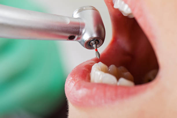 Best Emergency Dentist for Lost Fillings or Crowns in New Ellenton, SC